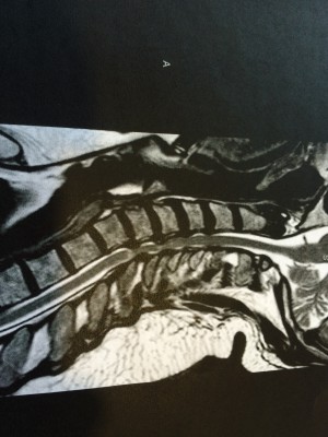 JBLs Stenosis MRI of 3-1-2016 .JPG