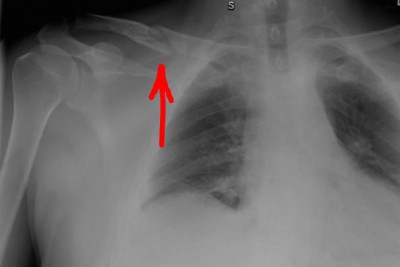 Clavicle4.JPG